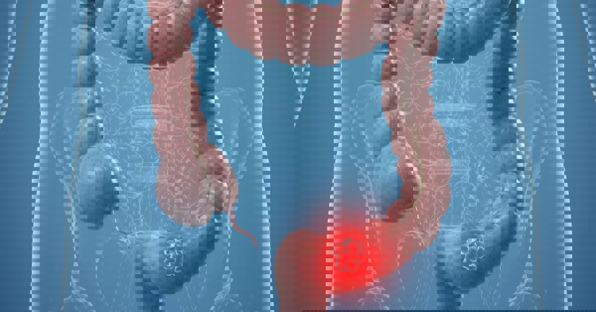 Colon Cancer Treatment