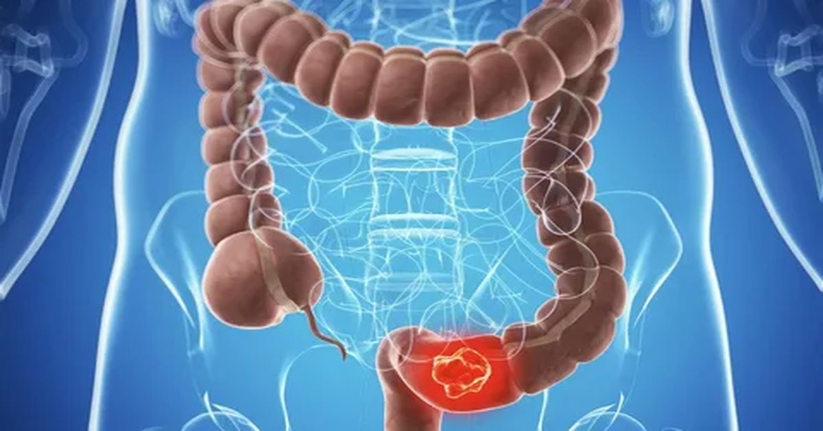 Colon Cancer Treatment