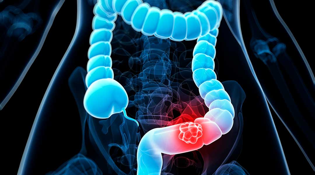 What Causes Rectum Cancer?