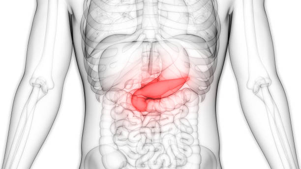 3 стадия рака поджелудочной железы