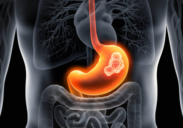 What are the Stages of Stomach Cancer?
