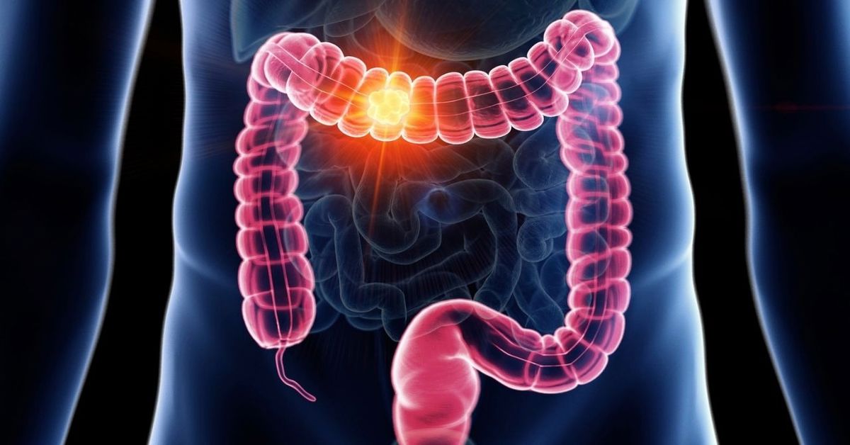 Colon Cancer Surgery