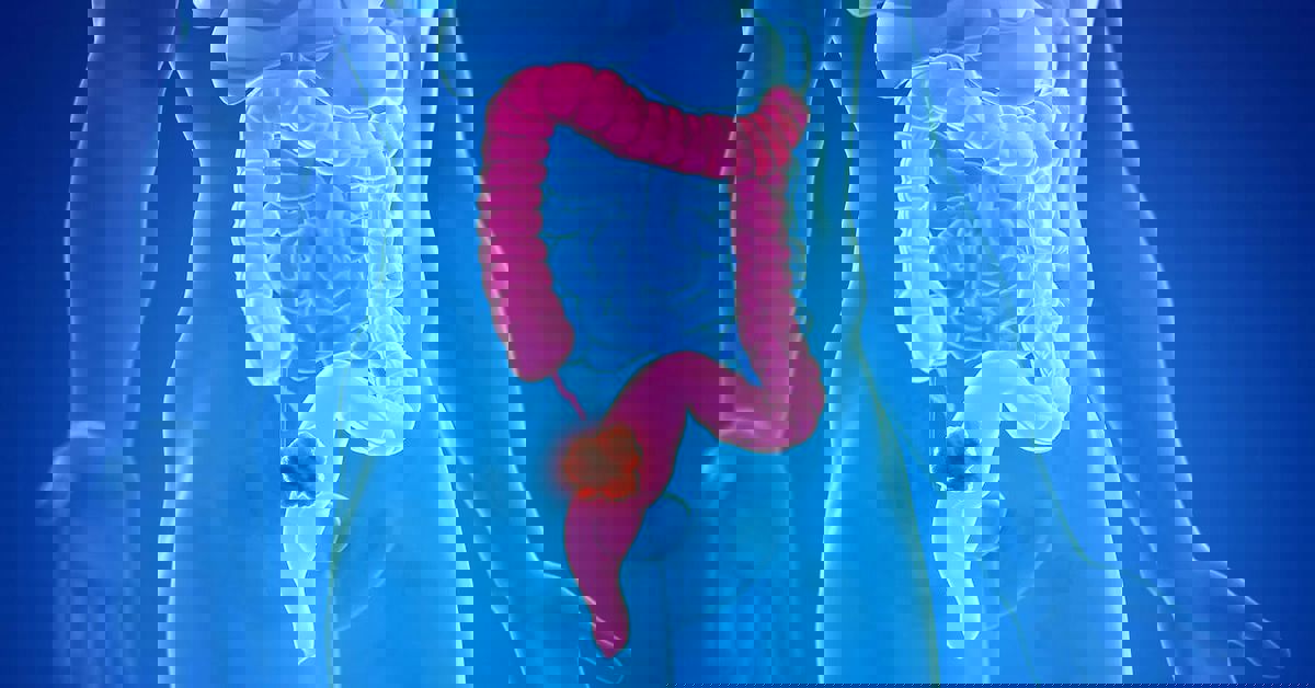 Colon Cancer Surgery