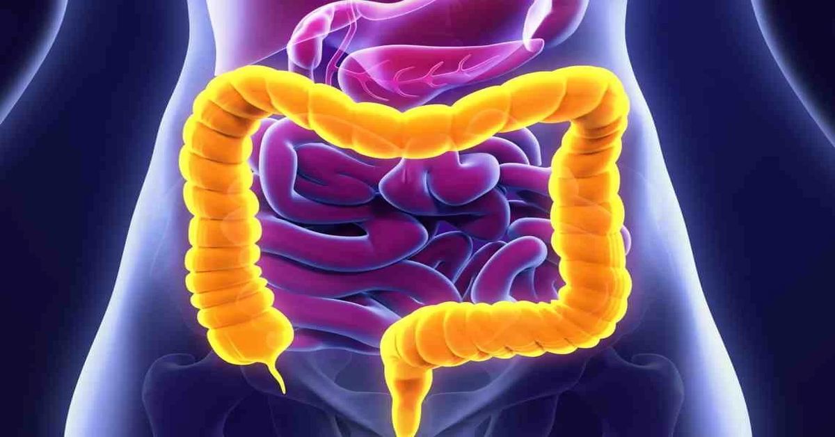 ما هو التهاب القولون التقرحي؟