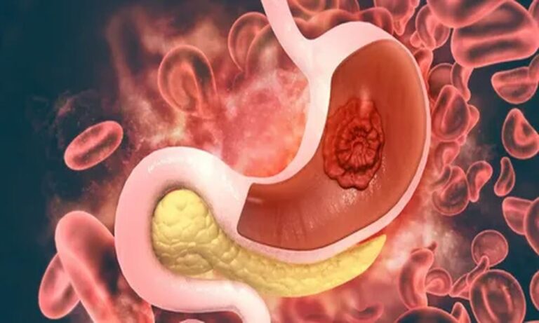 Tag Stomach Deformation