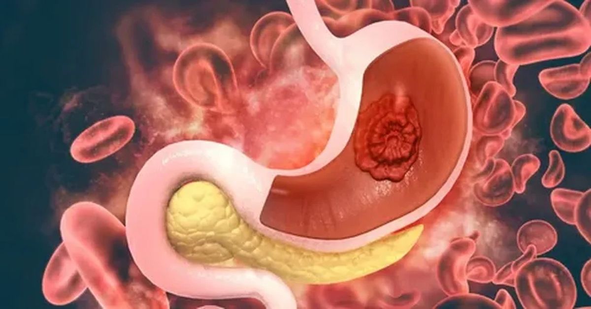 Mide Kanseri Nedir?