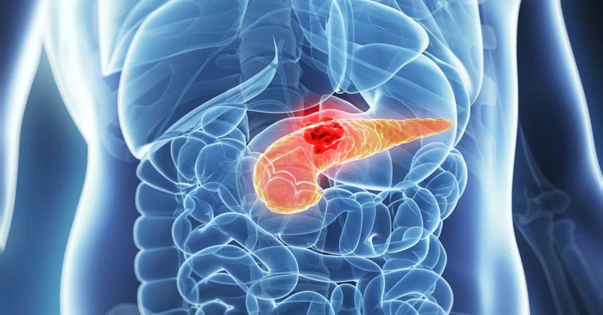 Pankreas Kanseri Ameliyatı