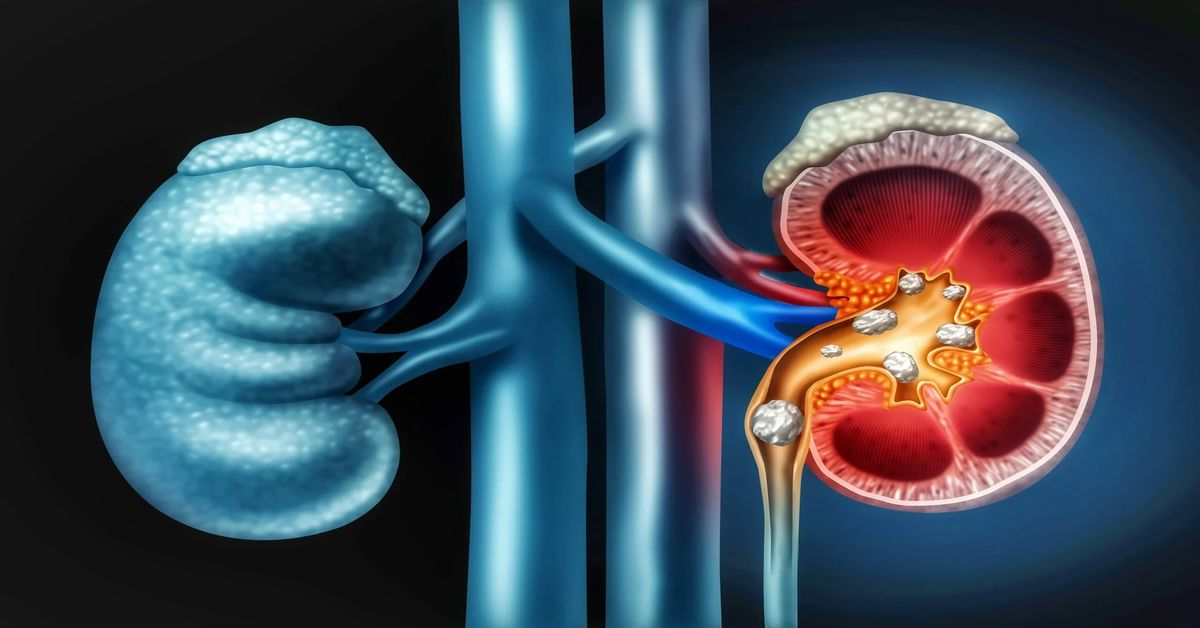 Böbrek Taşı