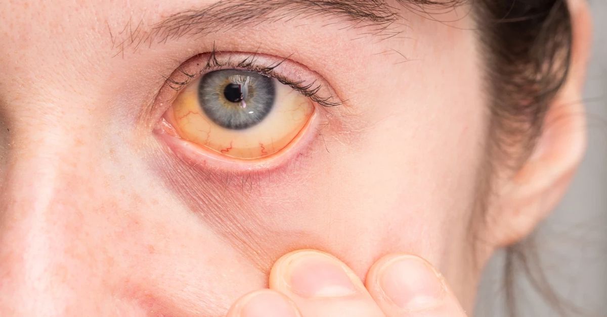 Karaciğer Tümörü Ameliyatı