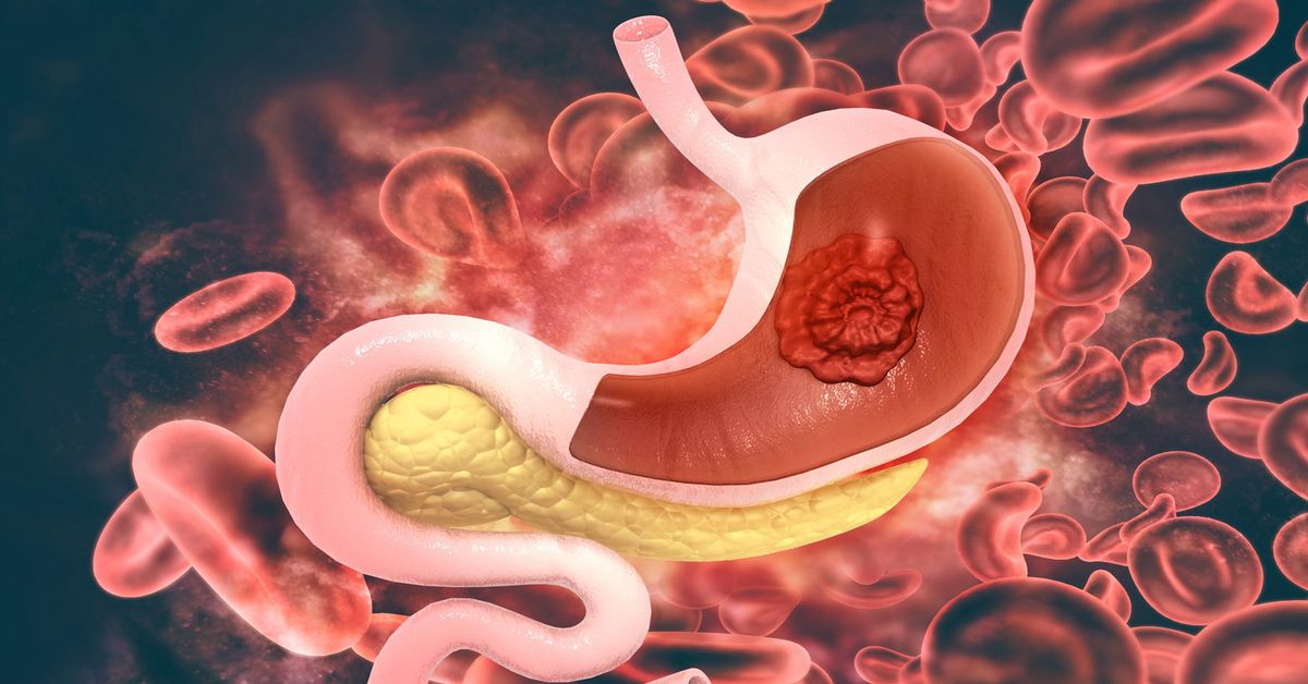 Stomach Cancer Treatment
