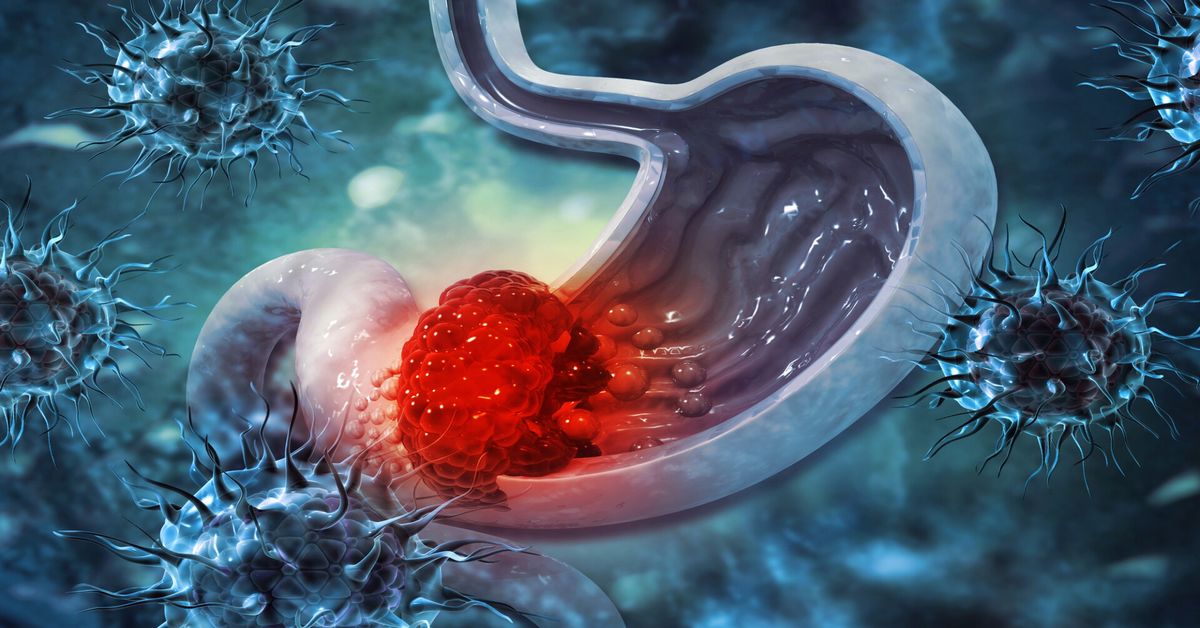 Stomach Cancer Treatment